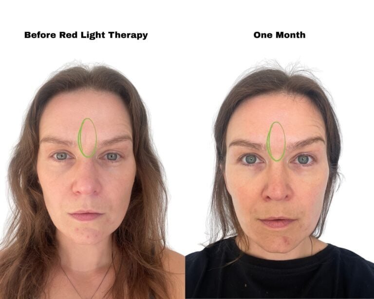 red light therapy one month results