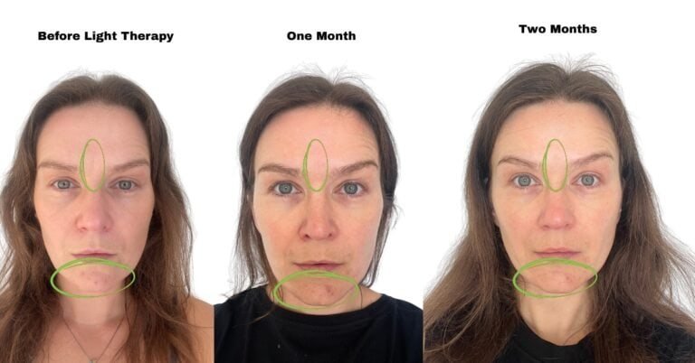 red ligh therapy before and after two month usage