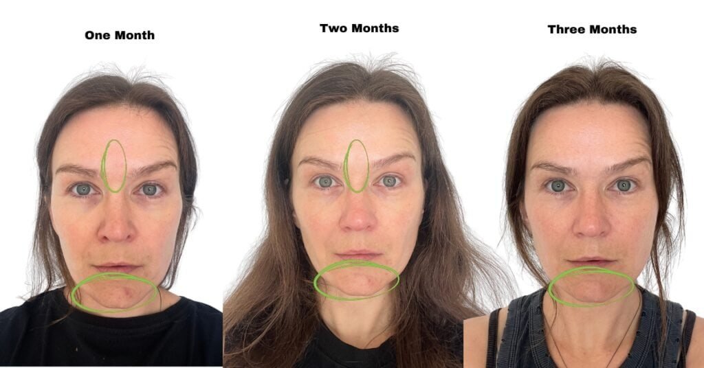 red light therapy mask before and after 3 months of usage